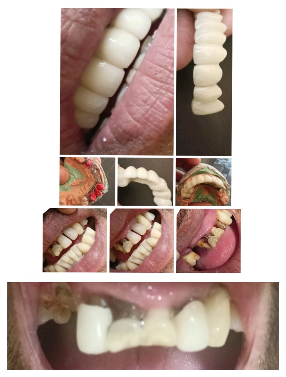 Dental Implant 1